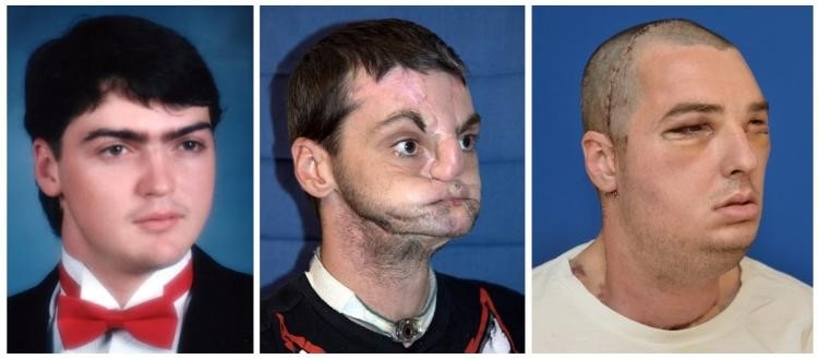Facial Transplants